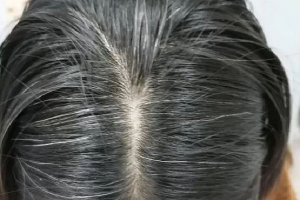 白頭發(fā)和性生活頻繁有關系嗎 白頭發(fā)是腎陰虛還是腎陽虛
