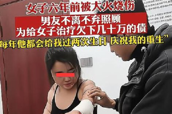 男子照顧大面積燒傷女友6年 大面積燒傷要多長(zhǎng)時(shí)間才會(huì)恢復(fù)